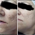 קרם חלזונות לשיקום מתיחת והצערת עור הפנים